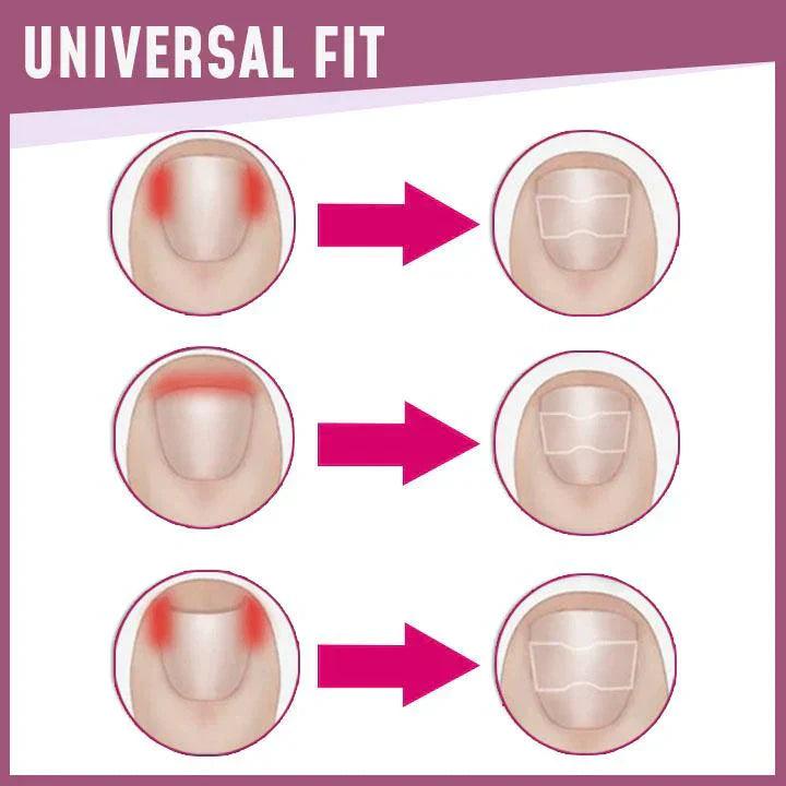 Lighteme Toenail Corrector Patches